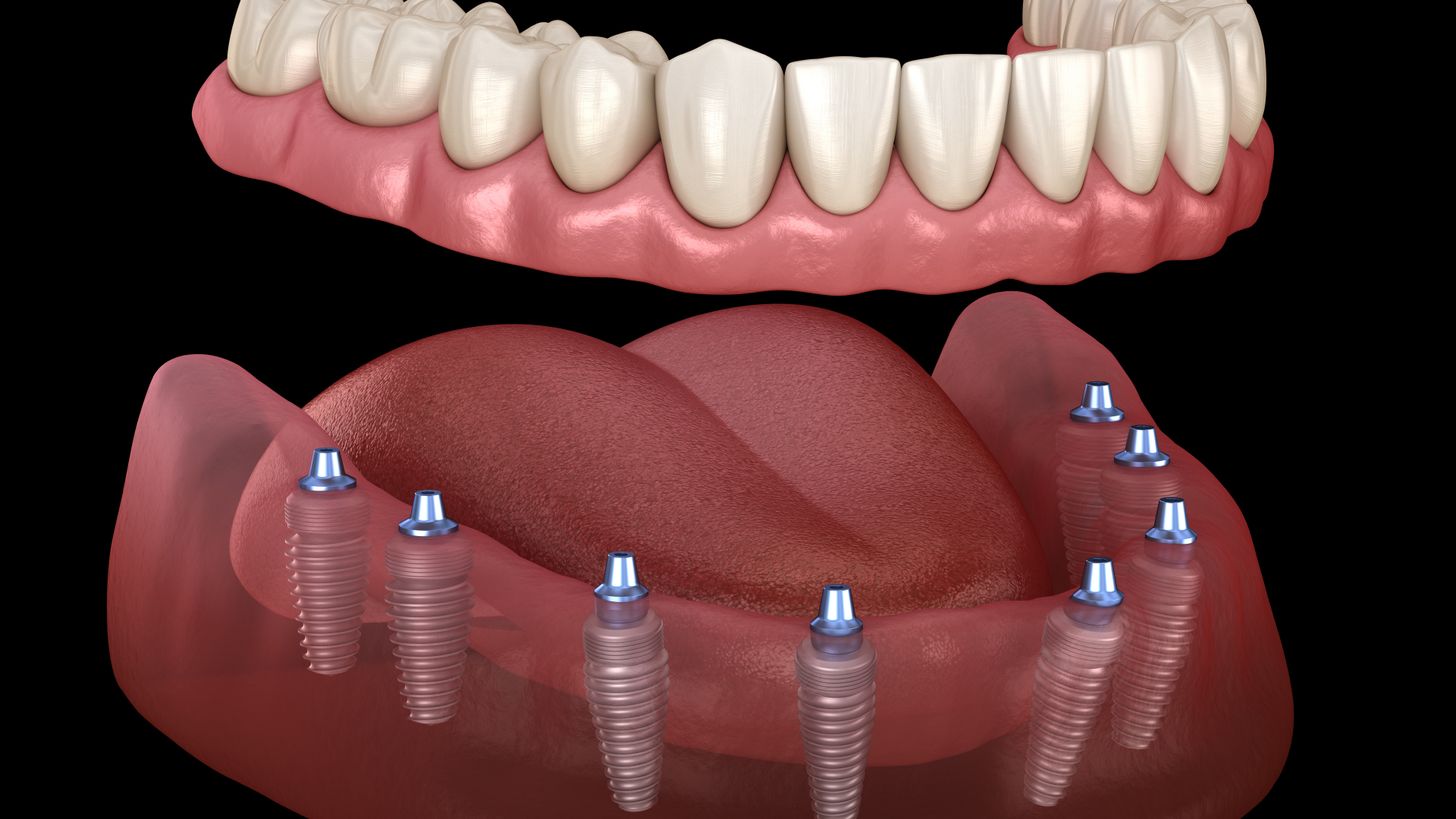 Fixed Artificial Teeth